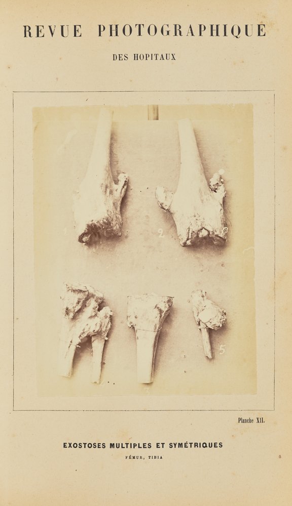 Mehrfache und symmetrische Exostosen, Femur, Tibia