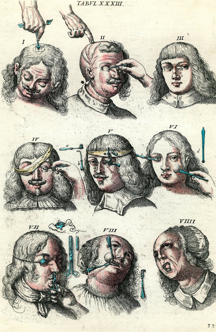 Chirurgie im 18. Jahrhundert: Trepanation und Operation von Auge und Gesicht. Gravur in „Institutionis chirurgicae“ von Lorenzo Heister von Anonymous Anonymous