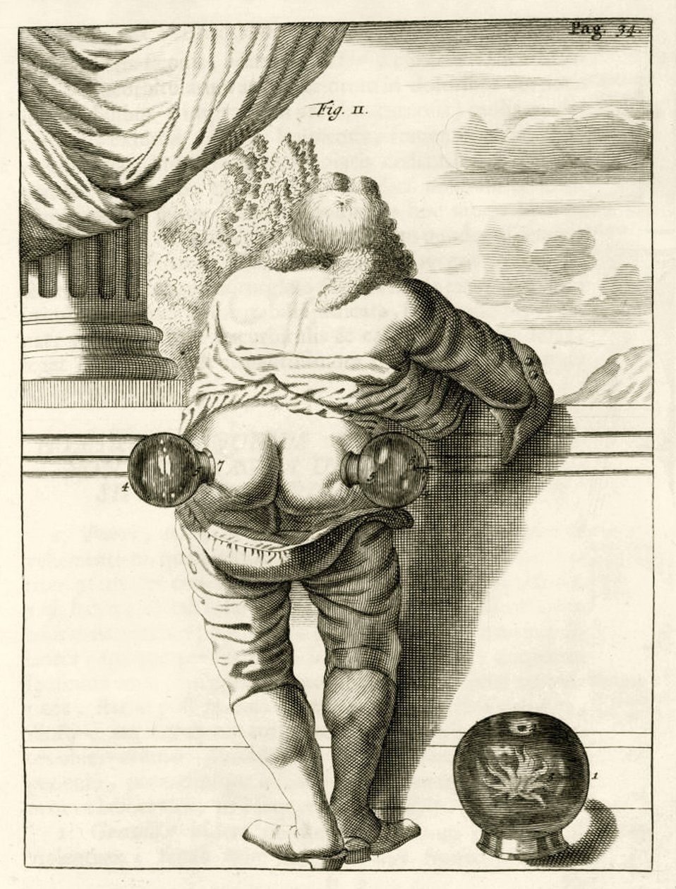 Ein Beispiel für Schröpfen, aus Exercitationes Practicae circa Medendi Methodum von Frederik Dekkers, 1694 von Dutch School