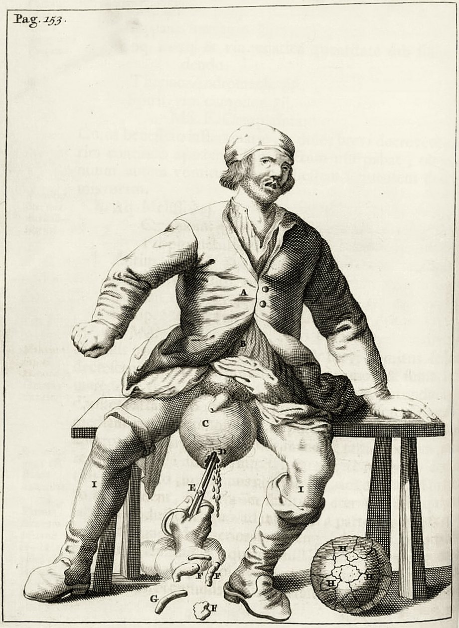 Abfluss von Flüssigkeit aus einem Hydrozele des Hodensacks, aus Exercitationes Practicae circa Medendi Methodum von Frederik Dekkers, 1694 von Dutch School
