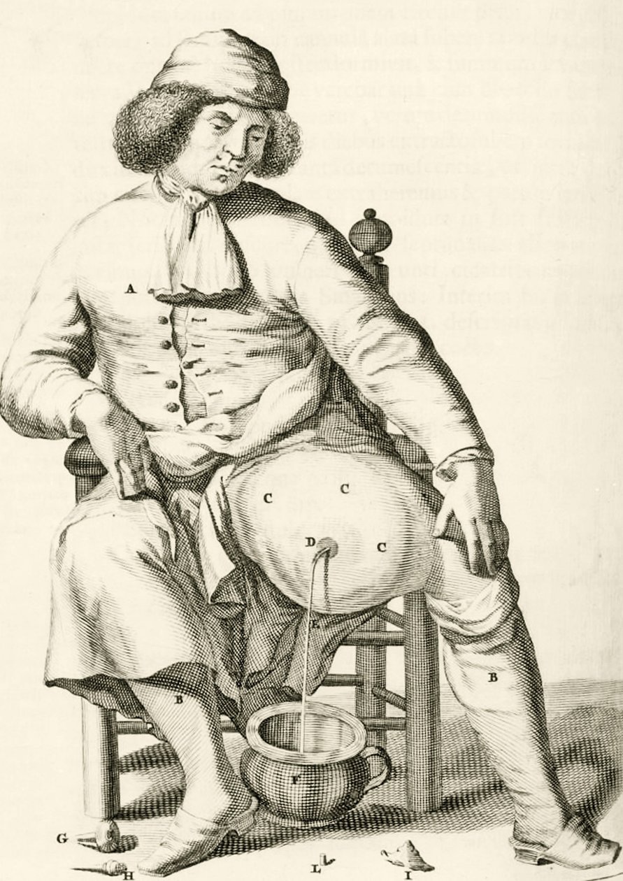 Abfluss von Flüssigkeit aus einem Abszess, aus Exercitationes Practicae circa Medendi Methodum von Frederik Dekkers, 1694 von Dutch School