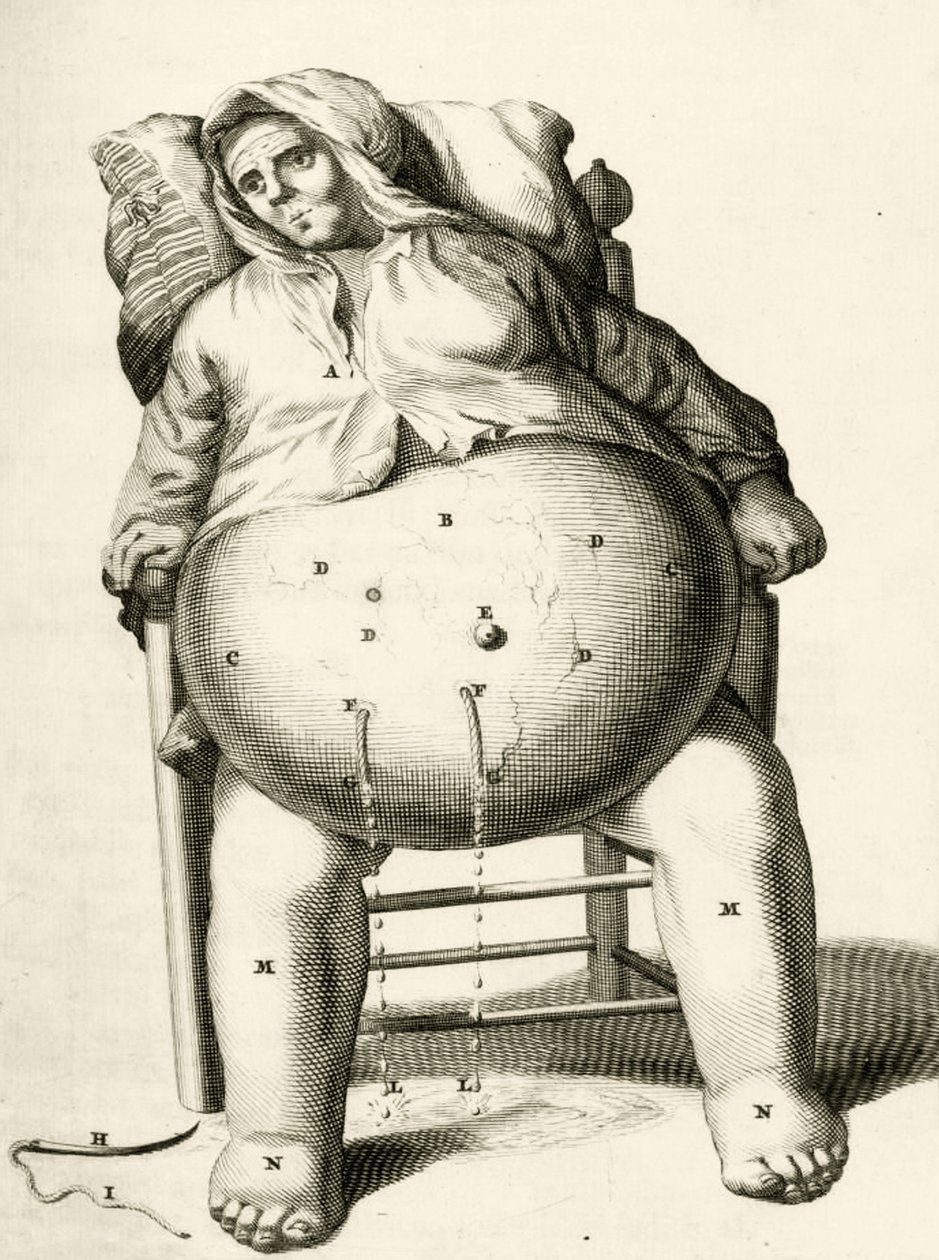 Abfluss von Flüssigkeit aus einem Abszess, aus Exercitationes Practicae circa Medendi Methodum von Frederik Dekkers, 1694 von Dutch School