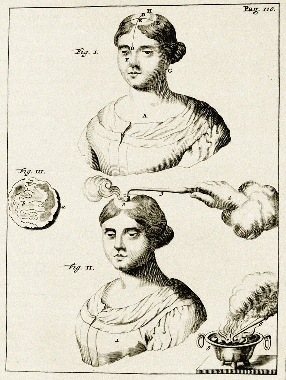 Behandlung eines Epilepsiekranken, aus Exercitationes Practicae circa Medendi Methodum von Frederik Dekkers, 1694 von Dutch School