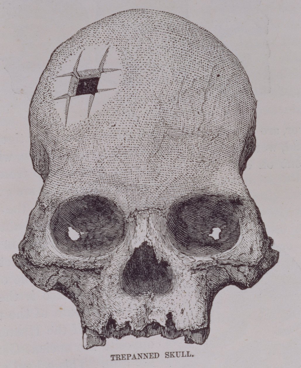 Trepannierter Schädel, aus 