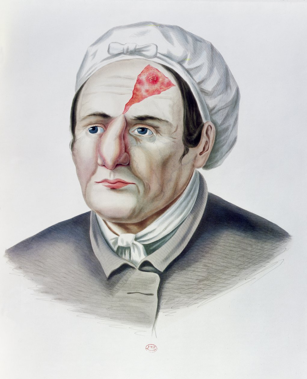 Nach einer Hauttransplantation, aus Selecta Praxis Medico-Chirurgica von Alexander Auvert, Paris, 1856 von French School