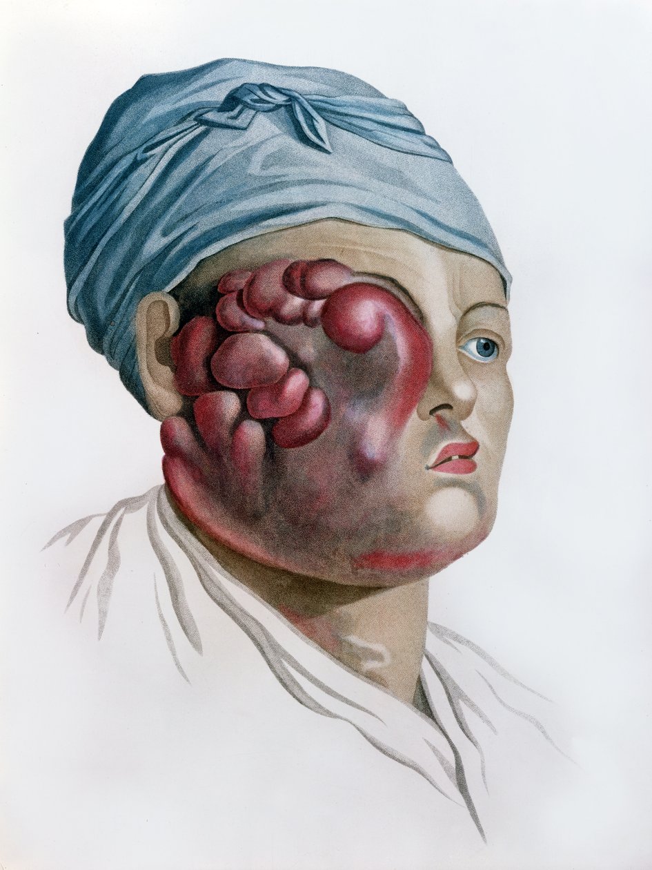Krebsartige Skrofulose, aus Description des Maladies de la Peau von Baron Jean Louis Alibert (1768-1837) Paris, 1806 von French School
