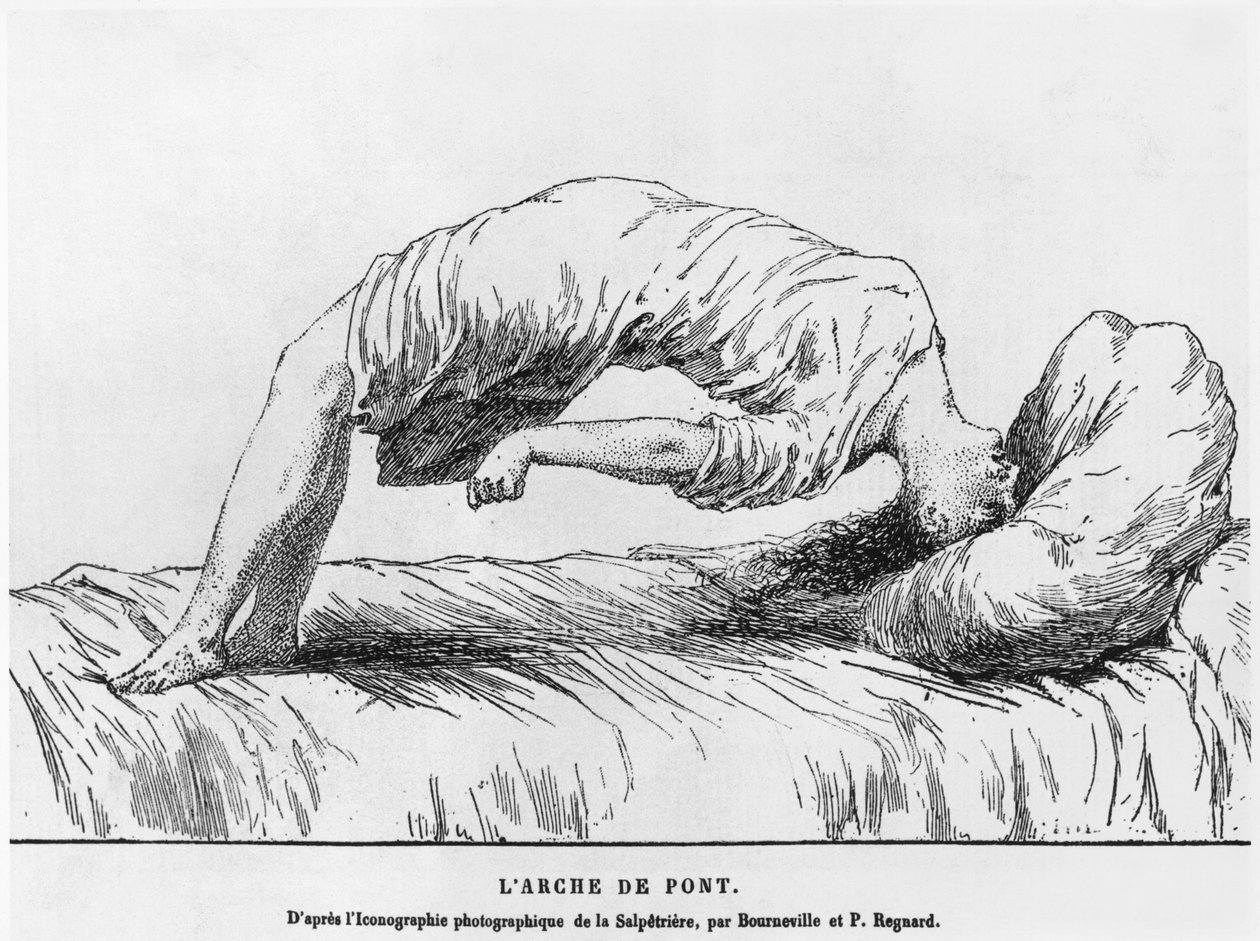 Hysterie und Schlafwandeln, aus Les Maladies Epidemiques de l