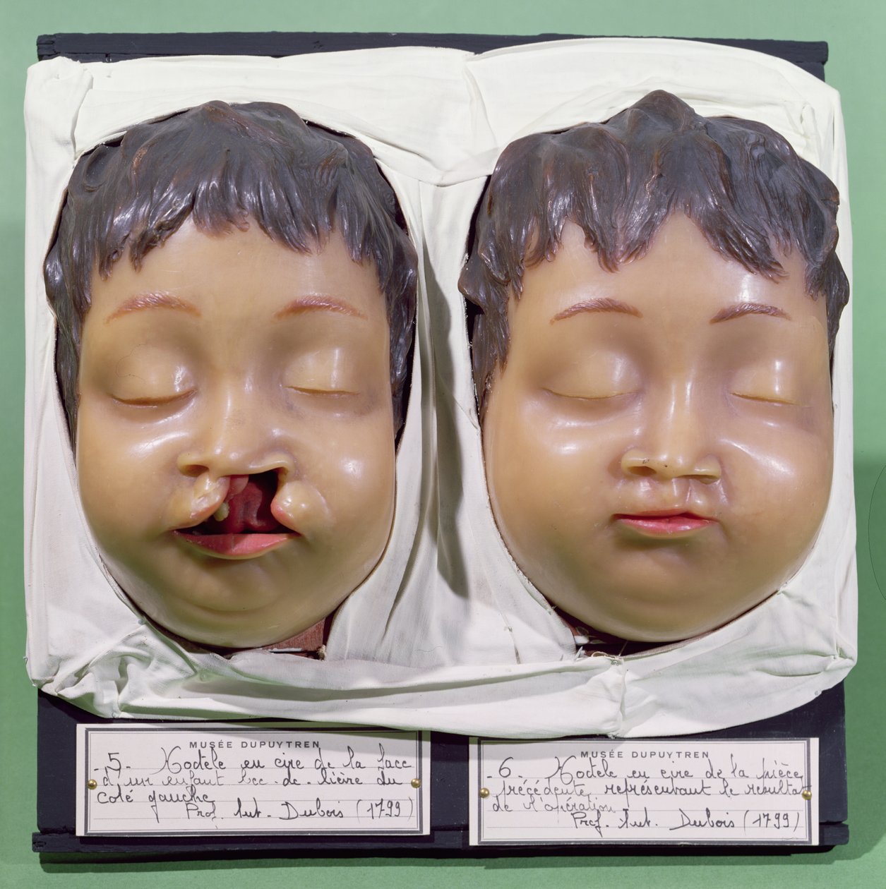 Modell, das ein Kinder Gesicht vor und nach einer Operation zur Korrektur einer Hasenscharte zeigt, durchgeführt von Antoine Dubois (1756-1837) im Jahr 1799 (Wachs) von French School