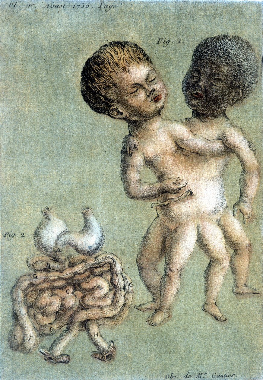 Medizinische Tafel, die siamesische Brüder darstellt: einen weißen und einen schwarzen. Illustration von Toussaint (1756) in „Periodische Beobachtungen über die Physik, die Naturgeschichte und die Künste“. von French School