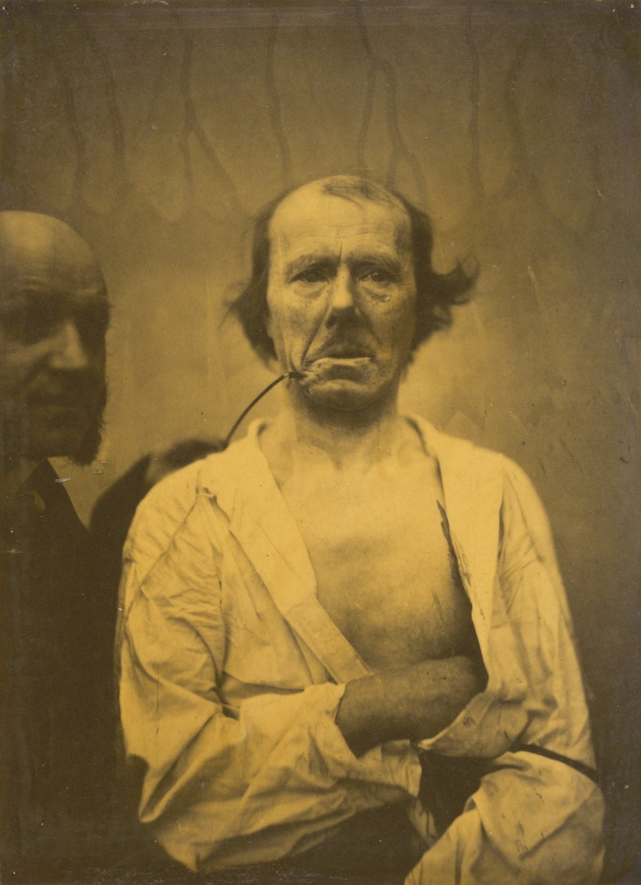 Ein entspannter Ausdruck (links); Ekel (rechts) von Guillaume Benjamin Armand Duchenne de Boulogne