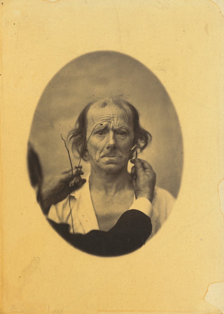 Unzufriedenheit, düstere Gedanken (links); Reflexion (rechts) von Guillaume Benjamin Amant Duchenne