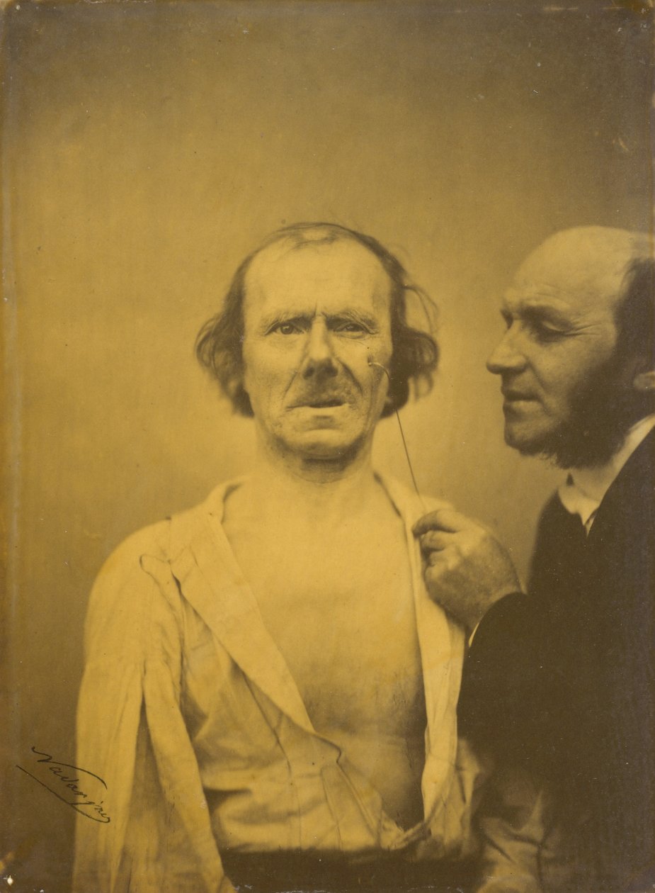 Weinen, Tränen des Mitleids (links); Entspanntes Gesicht (rechts) von Guillaume Benjamin Amant Duchenne