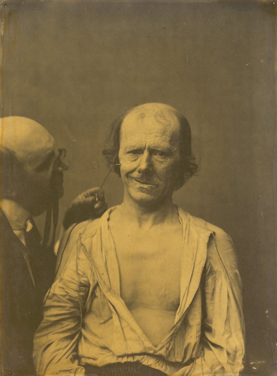 Ein entspanntes Gesicht (links); Falsche Freude oder Lachen (rechts), 1854-1856, gedruckt 1862 von Guillaume Benjamin Armand Duchenne de Boulogne