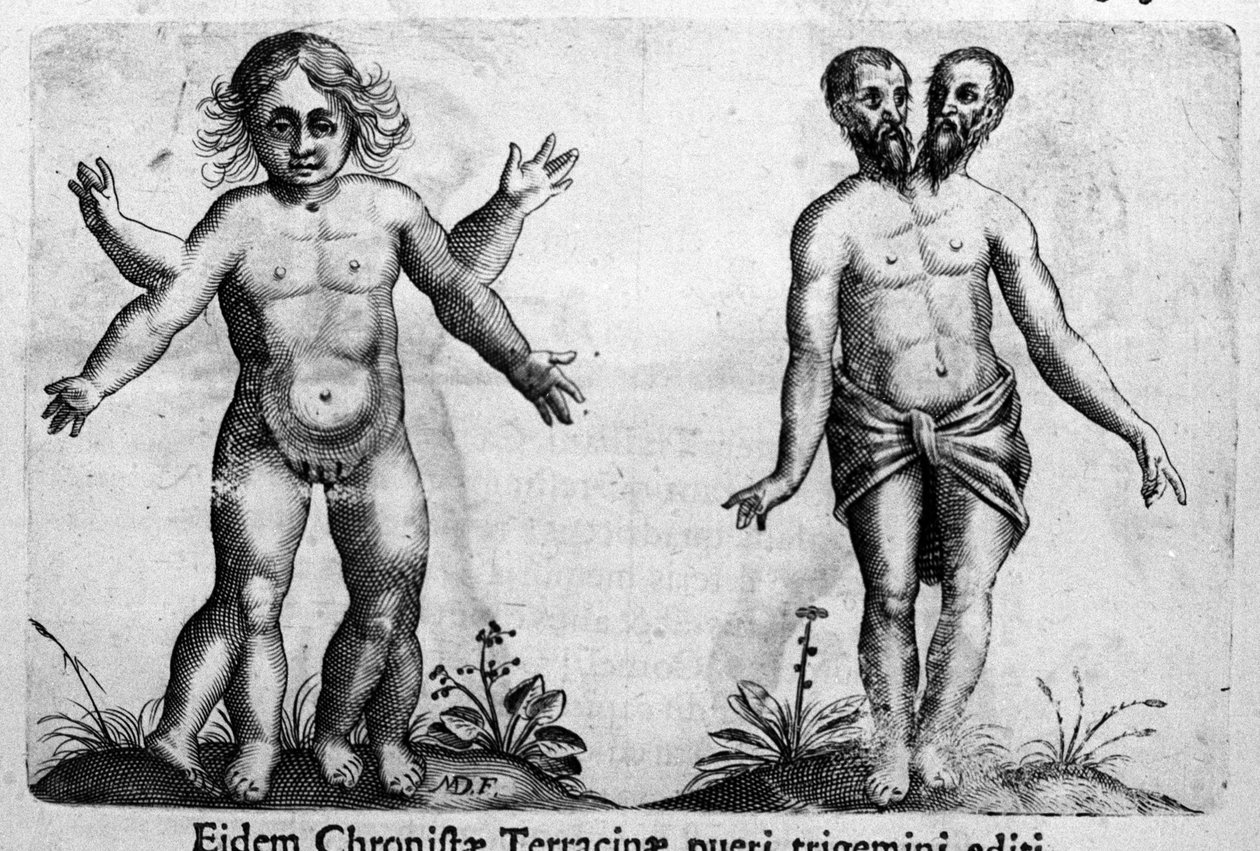 Verschiedene Arten von menschlichen Monstern. Gravur aus „De monstrorum natura, causis et differentiis“ von Fortunio Liceti (1577-1656), italienischer Wissenschaftler. 1646 von Italian School