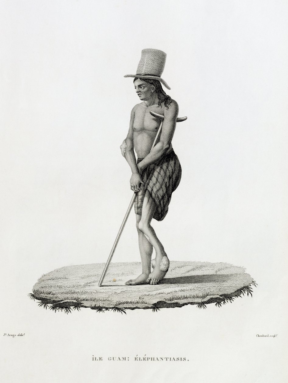 Guam: Ein Mann mit Elephantiasis, aus 