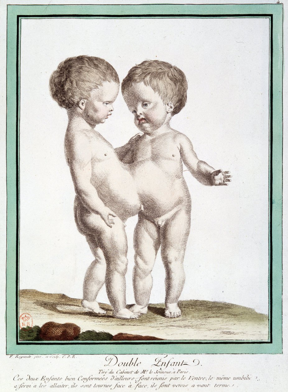 Siamesische Kinder - in „Les deviations de la nature“ von Régnault von Jean Baptiste Regnault