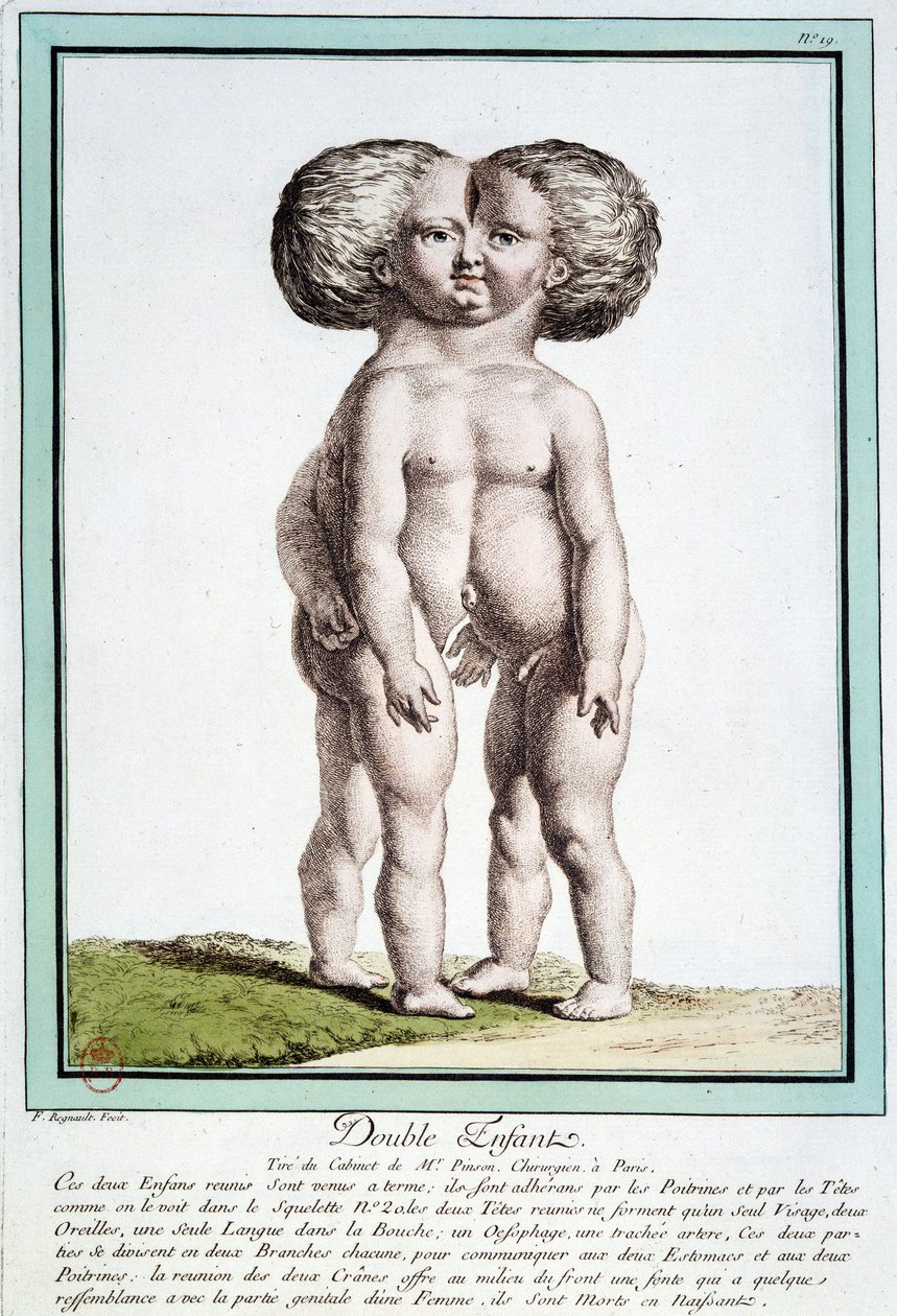 Siamesische Kinder - in „Les deviations de la nature“ von Régnault von Jean Baptiste Regnault