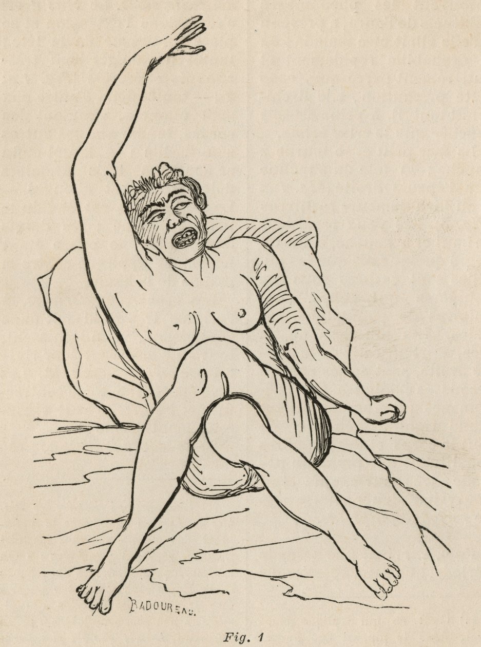Hysterische Epilepsie, Anfall, Verrenkungen, Abb. 1 aus 