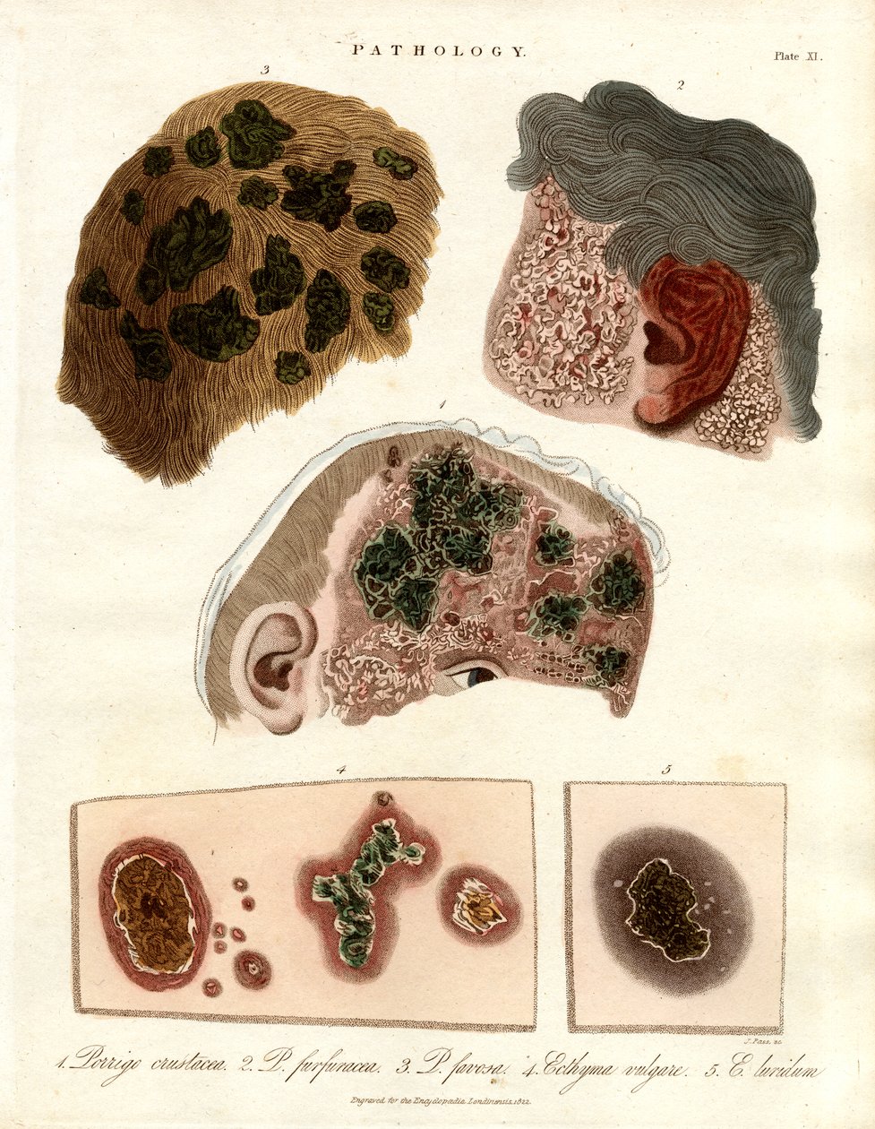 Pathologische Hautveränderungen: Porriga und Ecthyma von John Pass