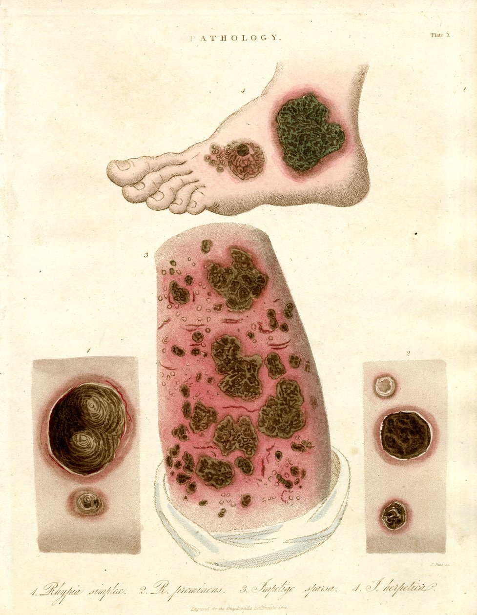 Pathologische Hautzustände - Pityria; Impetigo und Syphilis von John Pass