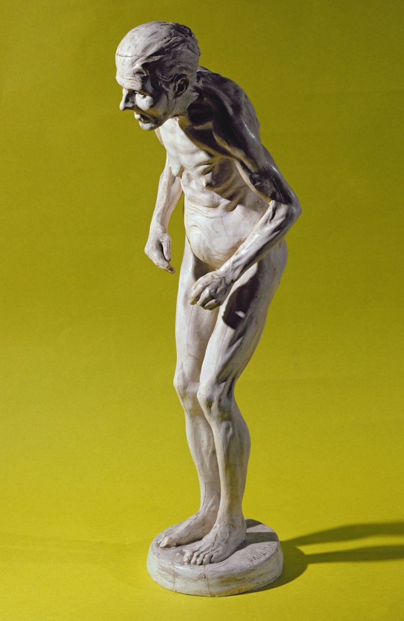 Figur einer Frau mit Parkinson-Krankheit von Paul Marie Louis Pierre Richer