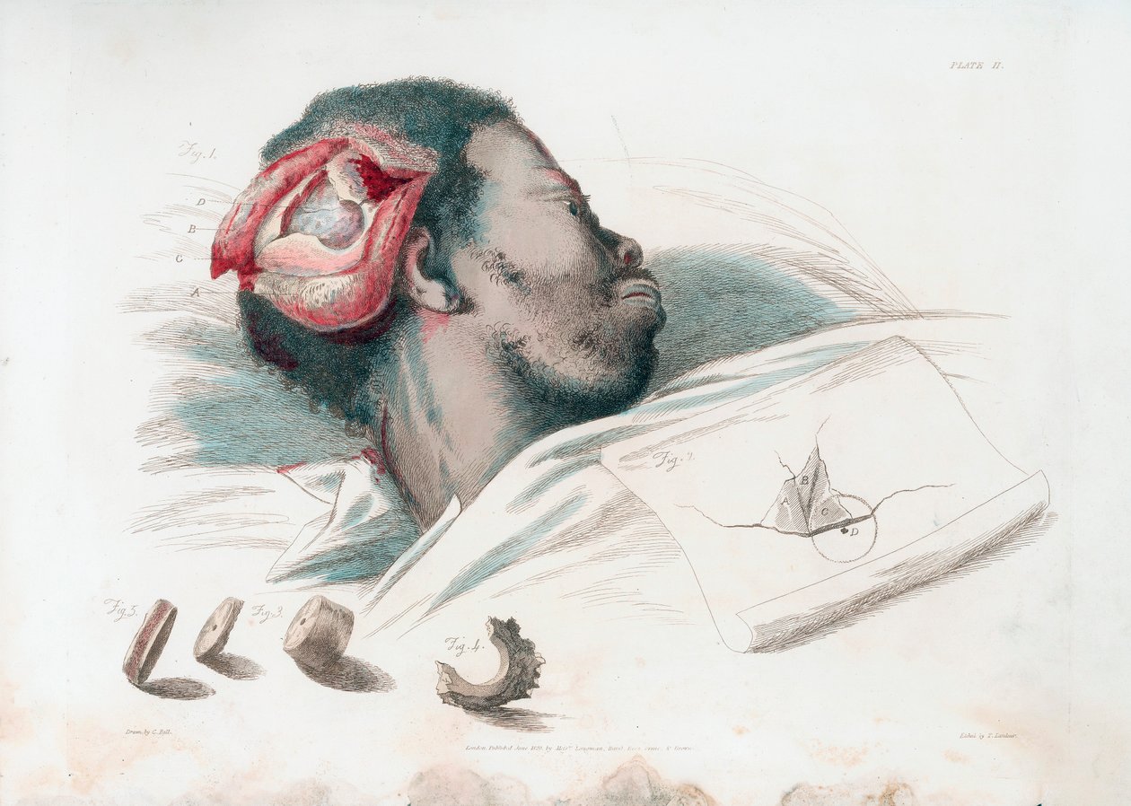 Ansicht der Wunde im Schädel nach Trepanation und Entfernung des zersplitterten Knochens unten links, 1821 von Thomas Landseer