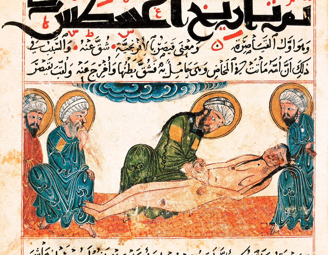 Darstellung eines Kaiserschnitts. Miniatur aus einem medizinischen Manuskript von Abu Raihan Al-Biruni (oder Alberuni) (973-1048), persischer Intellektueller und Wissenschaftler, Folio 161. von Unbekannt