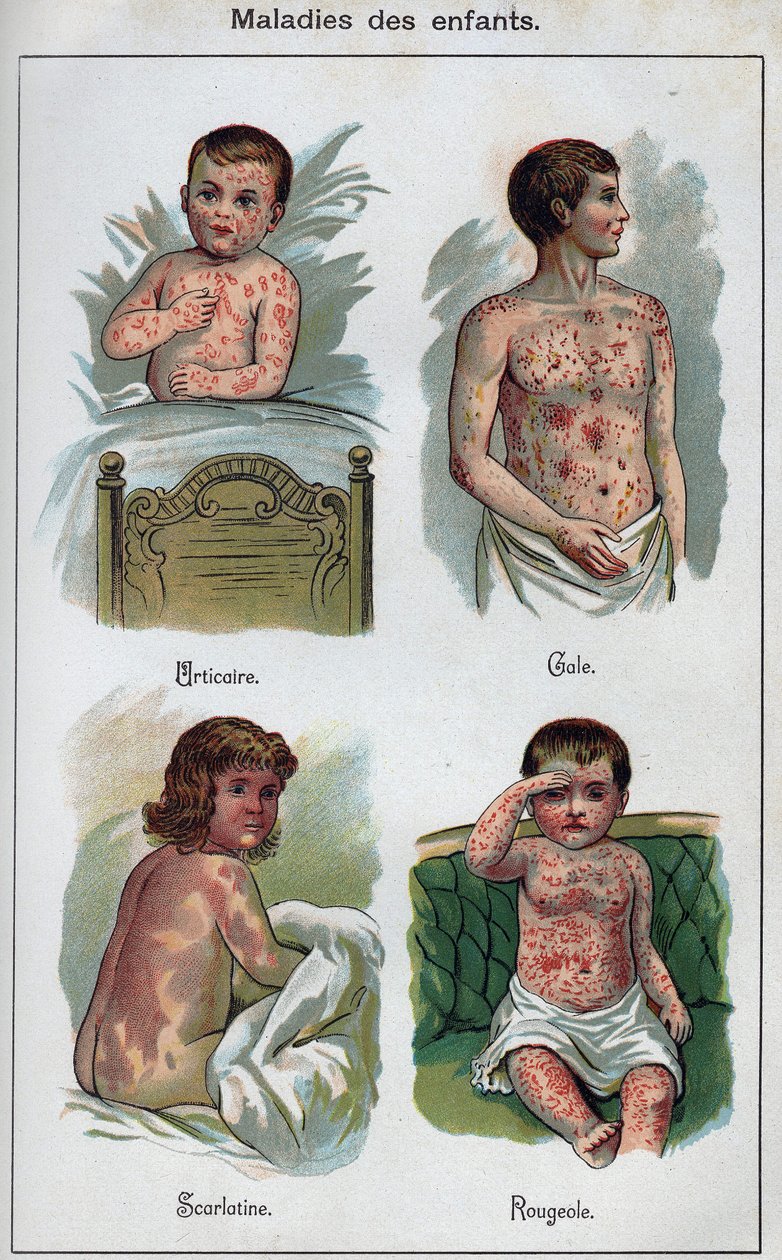 Kinderkrankheiten: Nesselsucht, Masern, Krätze, Scharlach. In „Die neue natürliche Heilung“ von F.E. Bilz. von Unknown artist