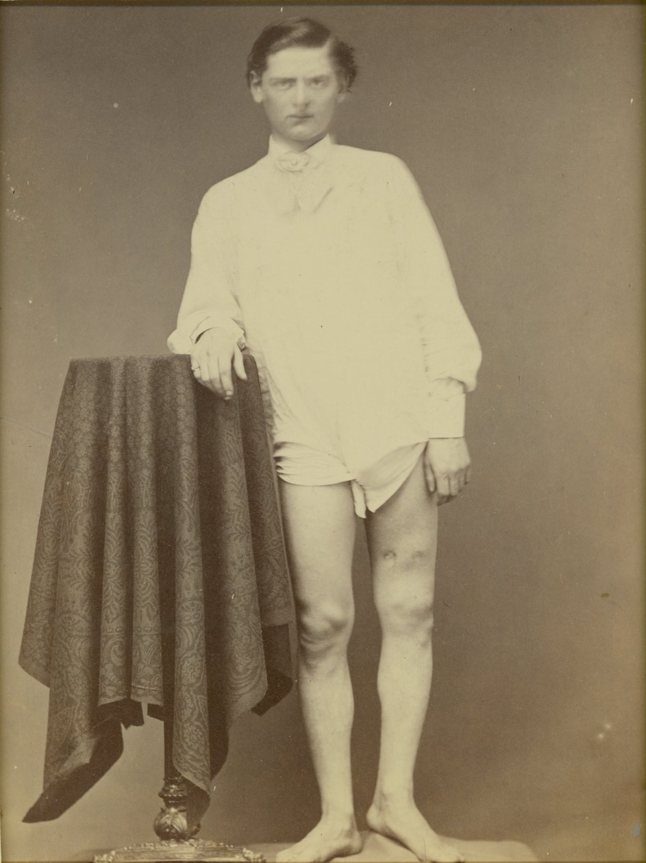 Verletzter Soldat des Bürgerkriegs (Private Charles Westerfield, Army Medical Museum Specimen No. 4278), April 1865 von William Abraham Bell