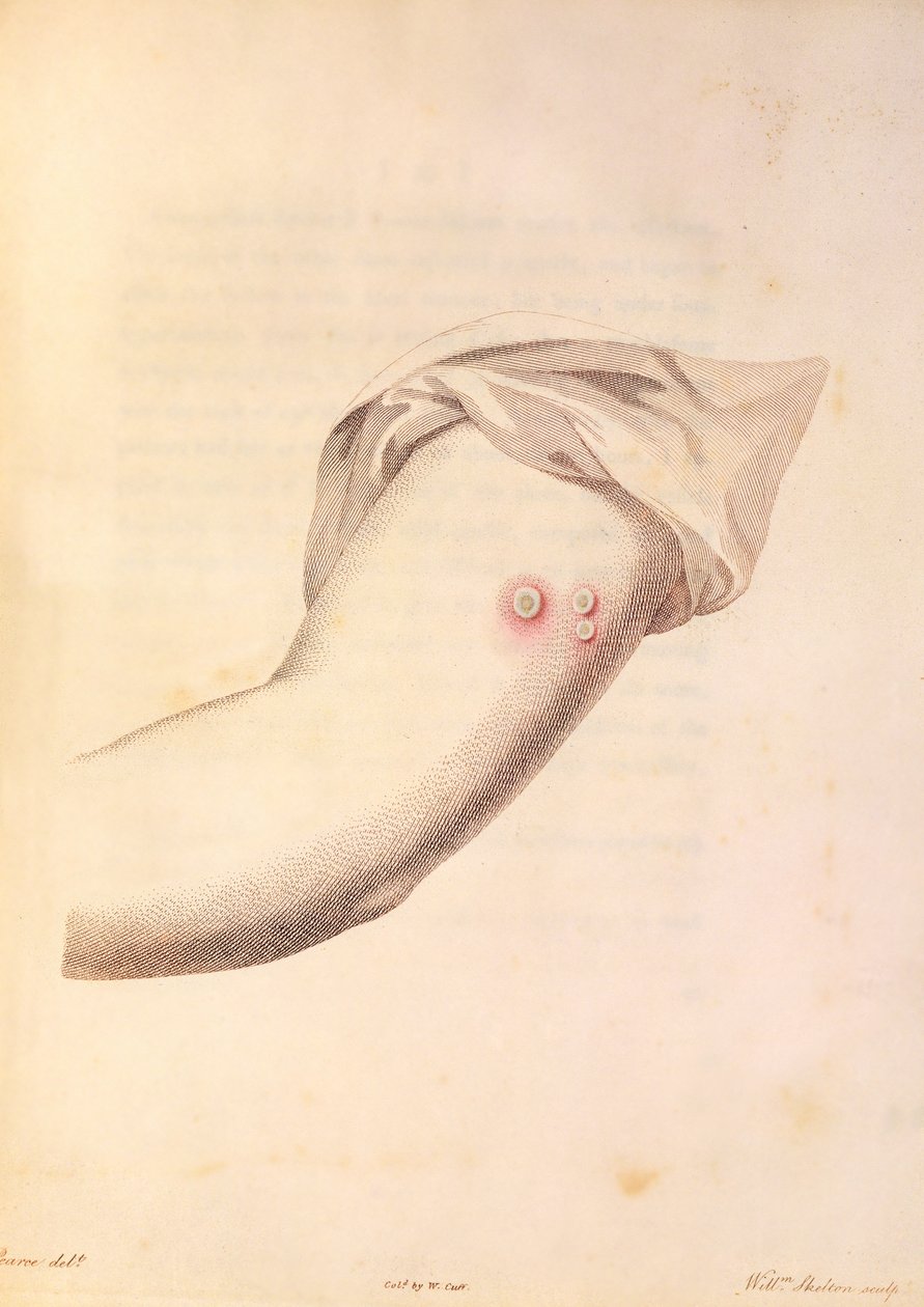 Arm von William Pead verwendet für Pockenimpfstoff, aus 