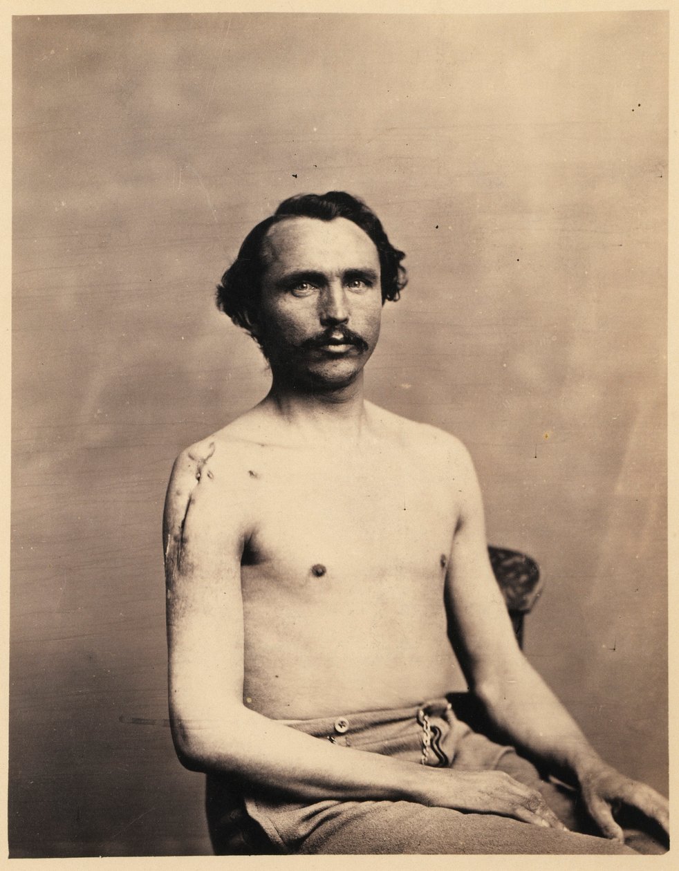 Private Adolph Zirsse, erfolgreicher Zwischenexzision des Kopfes und zweieinhalb Zoll des Schafts des rechten Humerus, aus dem fotografischen Katalog der chirurgischen Abteilung von William Bell