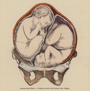 Normale Position von Zwillingen im Mutterleib während der Schwangerschaft von (after) French School