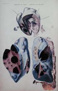 Herz- und Lungenapoplexie, Illustrationsplatte aus 