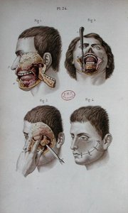 Anatomische Platte des Oberkiefers