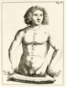 Beispiel für angeborene Geburtsfehler, aus Exercitationes Practicae circa Medendi Methodum von Frederik Dekkers, 1694