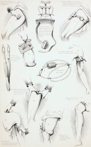 Methoden zur Blutstillung, um 1890 von English School