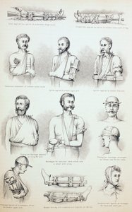 Vorübergehende Behandlung von Frakturen, um 1890