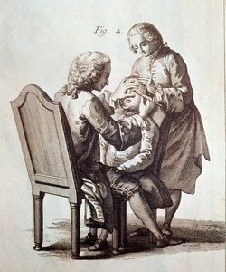Ein Arzt operiert einen Katarakt-Patienten, Illustration aus der Medizinischen Enzyklopädie von Denis Diderot und Jean le Rond d