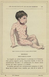 Aussehen und Verteilung der Masernflecken zu Beginn des Ausbruchs von French School