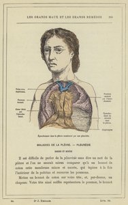 Erguss in die Pleura verursacht durch eine Pleuritis von French School