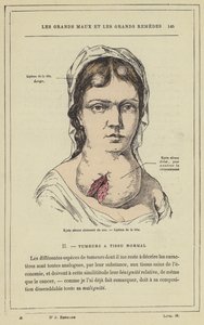 Septierter seröser Zyste am Hals, Lipom des Kopfes von French School