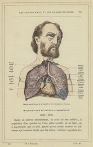 Charakteristische Läsionen der Bronchitis und der Bronchiektasie von French School