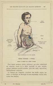 Charakteristische Läsionen des Typhus von French School