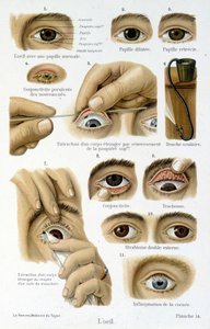 Medizin: das Auge von French School