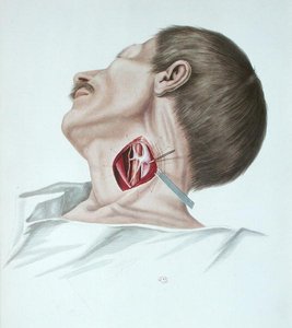Operation an einem Aneurysma, aus 