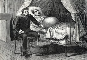 Patient mit fortgeschrittener Leberzirrhose, Arzt führt eine Punktion durch (Gravur) 1888