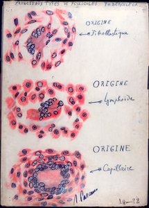 Prinzipielle Tuberkulose-Follikel