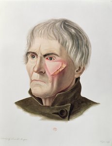 Hauttransplantationsoperation, aus Selecta Praxis Medico-Chirurgica von Alexander Auvert, Paris, 1856