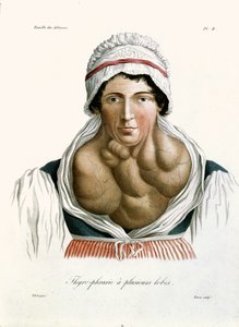 Schilddrüsenerkrankung, aus einem Buch von Baron Jean Louis Alibert (1768-1837) 1817