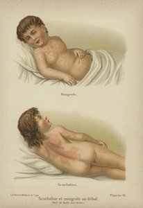 Frühe Symptome von Masern und Scharlach